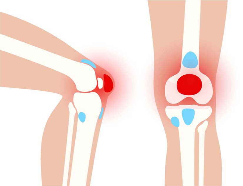 Боль при сгибании колена коленом лечение